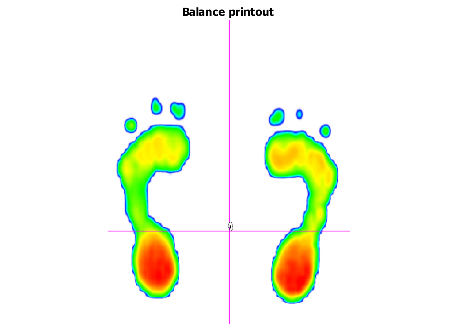 An image showing both feet with large red pressure areas through both heels